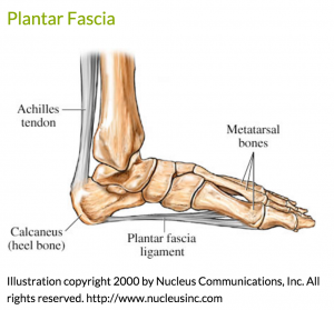 plantar fasciitis